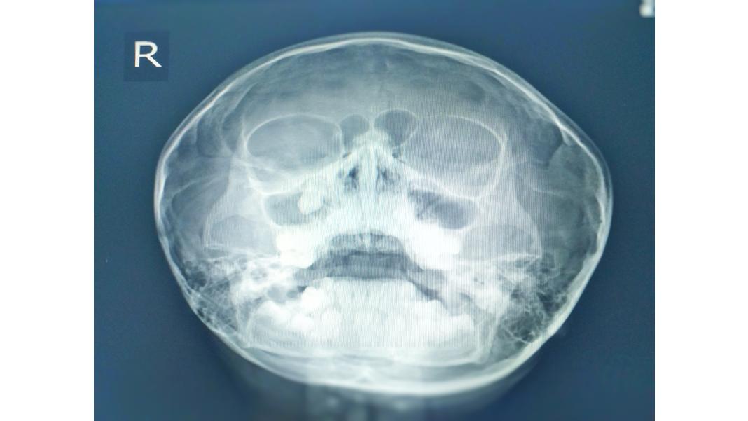 Descoperă Beneficiile Serrapeptazei: De la Sănătatea Cardiovasculară la Gestionarea Durerii și Inflamației