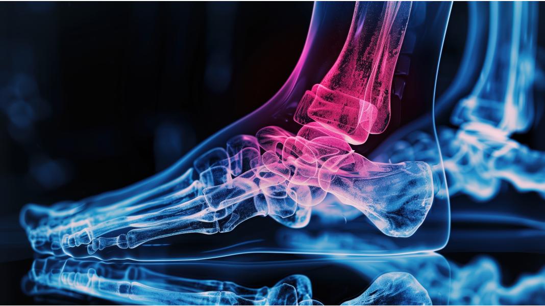 Pintenii Osoși: Cauze, Simptome și Remedii Naturale pentru Ameliorarea Durerii